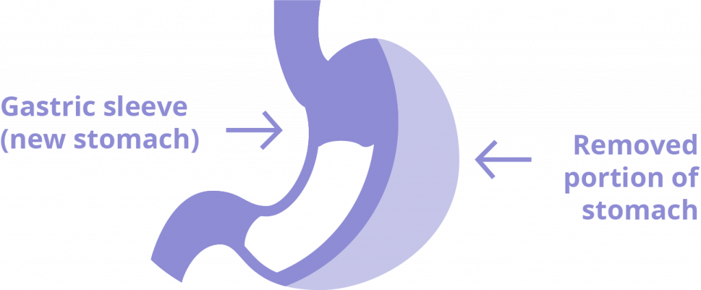 Gastric Sleeve Surgery in Tijuana, Mexico CER Bariatrics