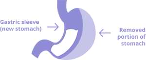 Gastric Sleeve in Mexico image of a stomach