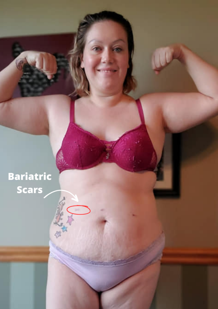 BARIATRIC SURGERY SCARS