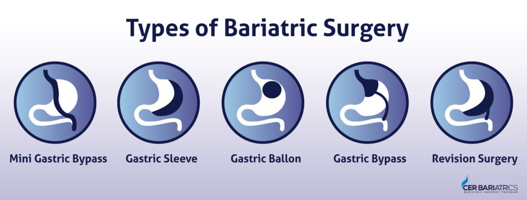 Subway Bariatric Friendly Menu: After Gastric Sleeve, Gastric Bypass -  Renew Bariatrics