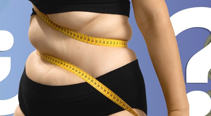 Mini Gastric byPass Principal Image