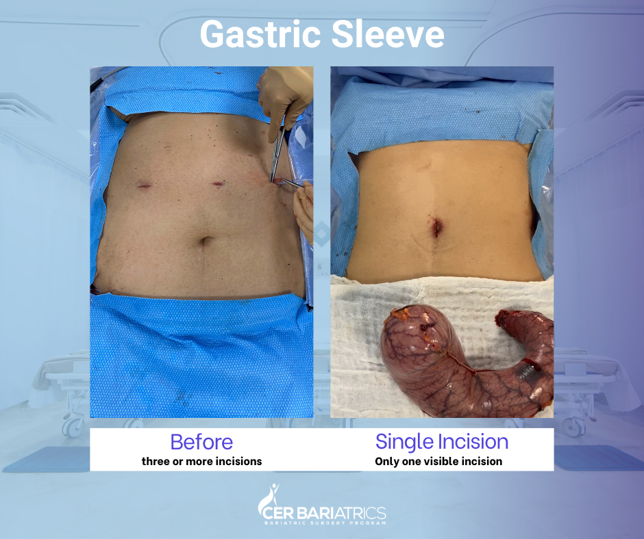 gastric sleeve scar