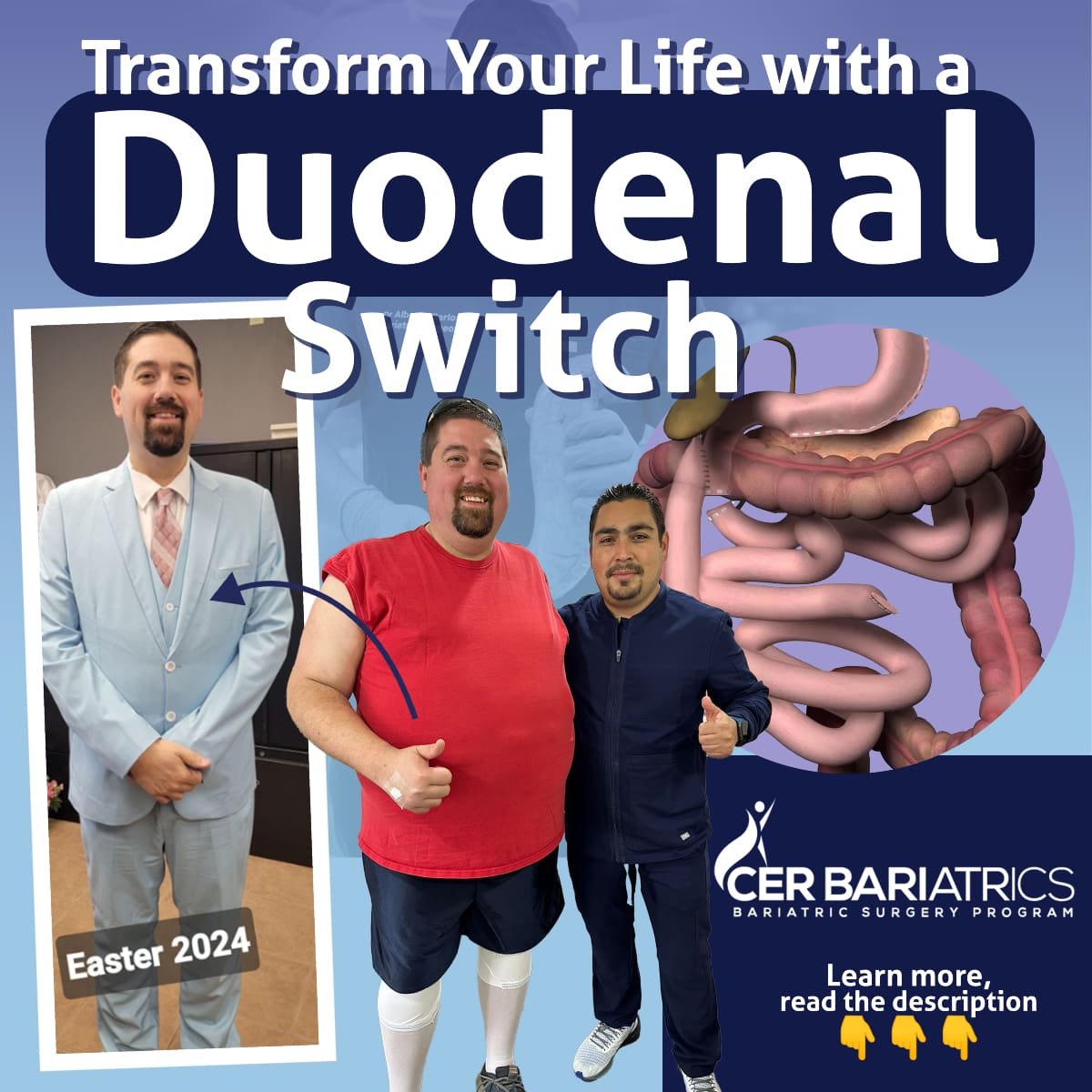 duodenal switch before and after review