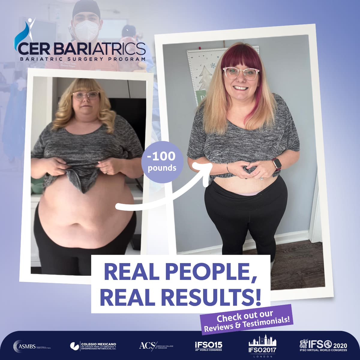 Before and after photo of a patient during the Evaluation Tour at CER Bariatrics.